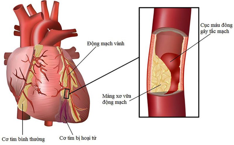 Mảng xơ vữa động mạch làm hẹp lòng động mạch chi dưới làm giảm lưu lượng máu lưu thông