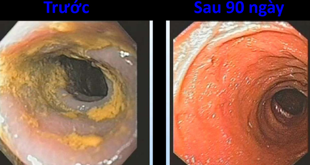 Hình ảnh tình trạng đường ruột trước khi sử dụng nước ion kiềm ở bên trái và kết quả sau 90 ngày là bên phải